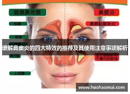 缓解鼻窦炎的四大特效药推荐及其使用注意事项解析 缓解鼻窦炎的四大特效药推荐及其使用注意事项解析